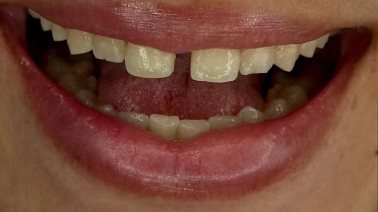 Antes — Diseño de sonrisa en resina premium