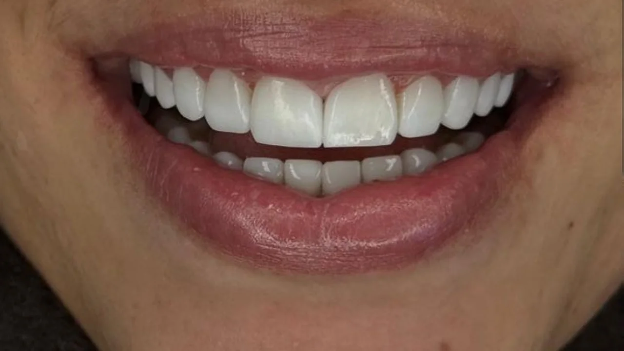 Después — Diseño de sonrisa en resina premium