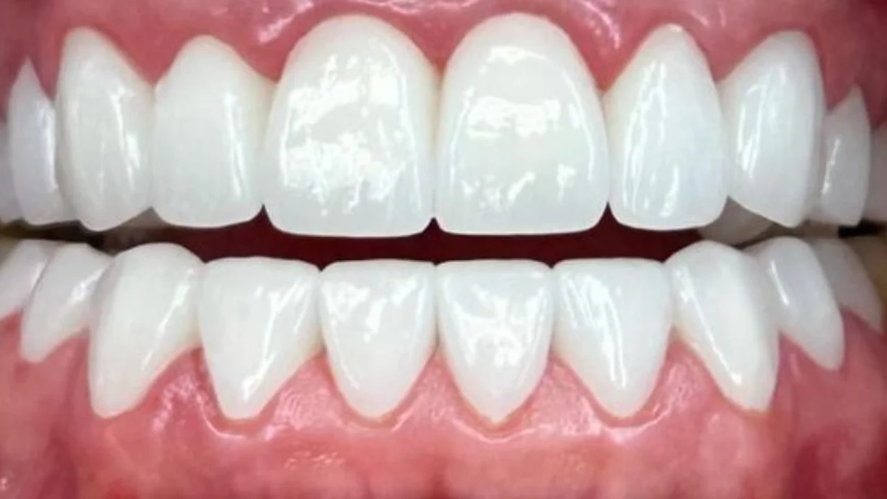 Después — Diseño de sonrisa natural