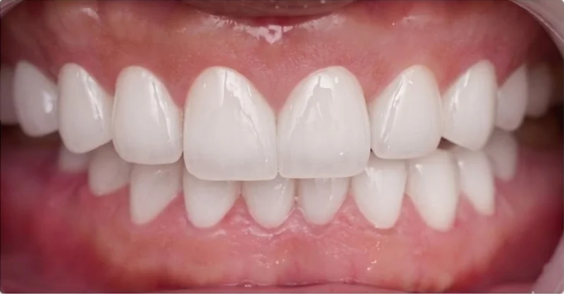 Después — Diseño de sonrisa personalizado