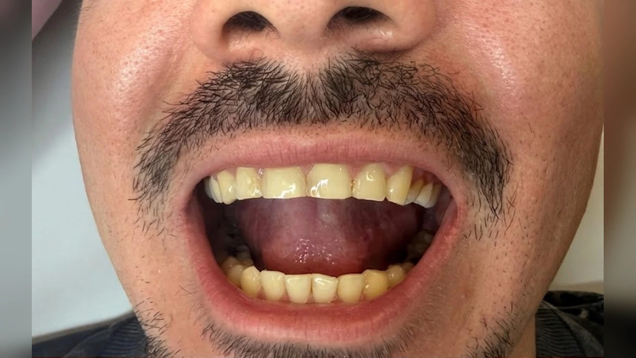 Antes — Diseño de sonrisa armónico