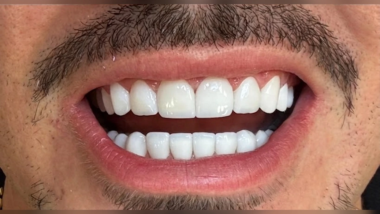 Después — Diseño de sonrisa armónico